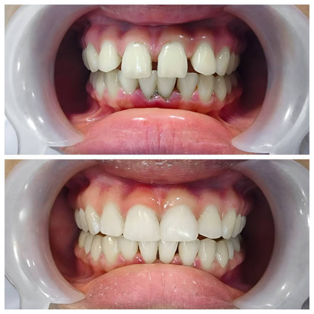 Full Mouth Reconstruction in Livingston, LA